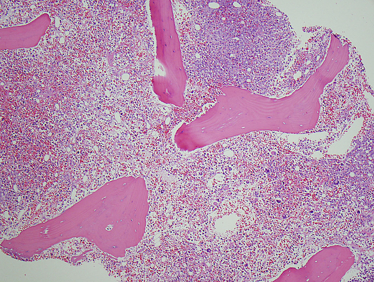 The bone marrow was markedly hypercellular, with sheets of primitive cells and areas of megakaryocytic proliferation (H&E).